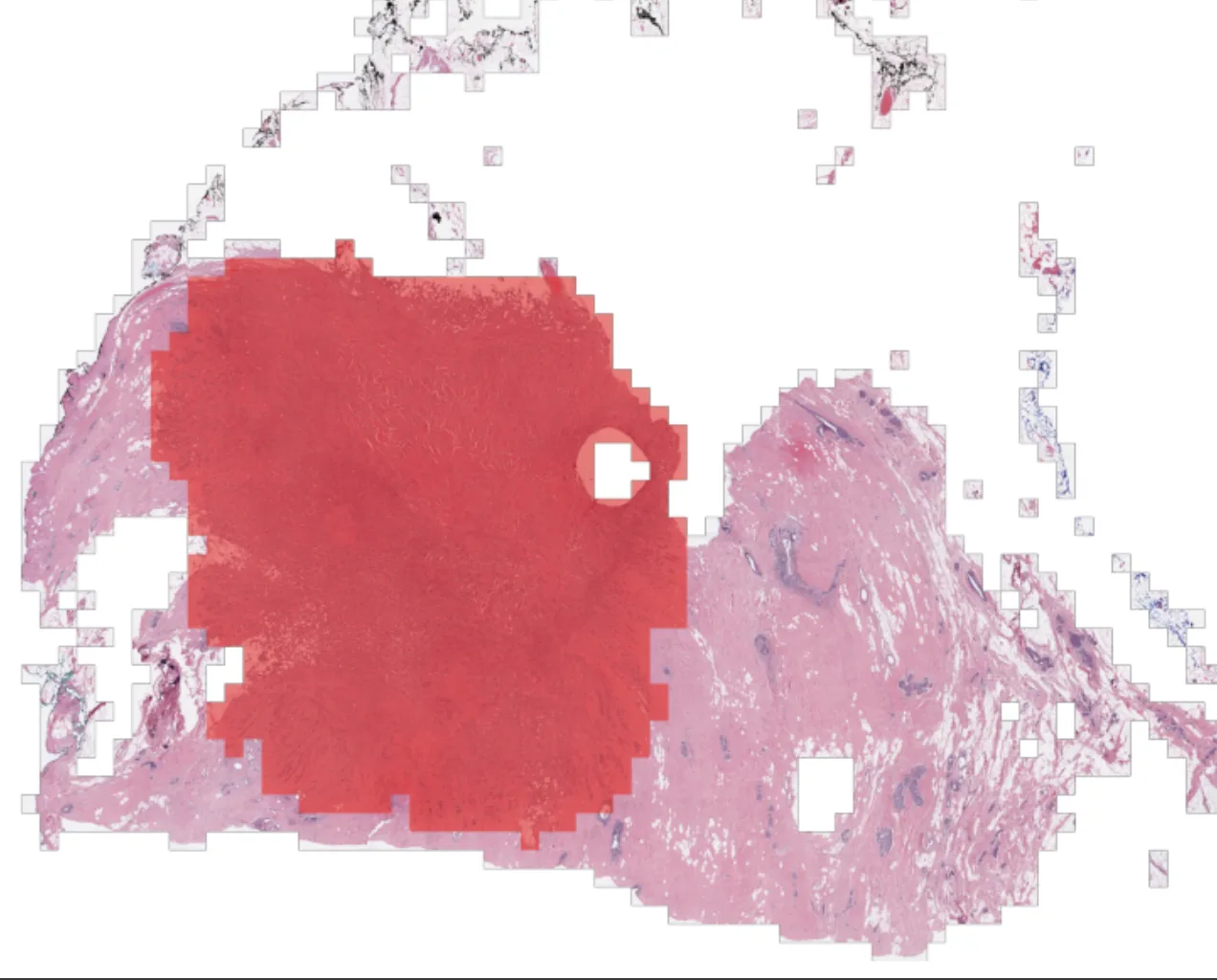 Breast tissue reconstruction with a red cancer detection overlay